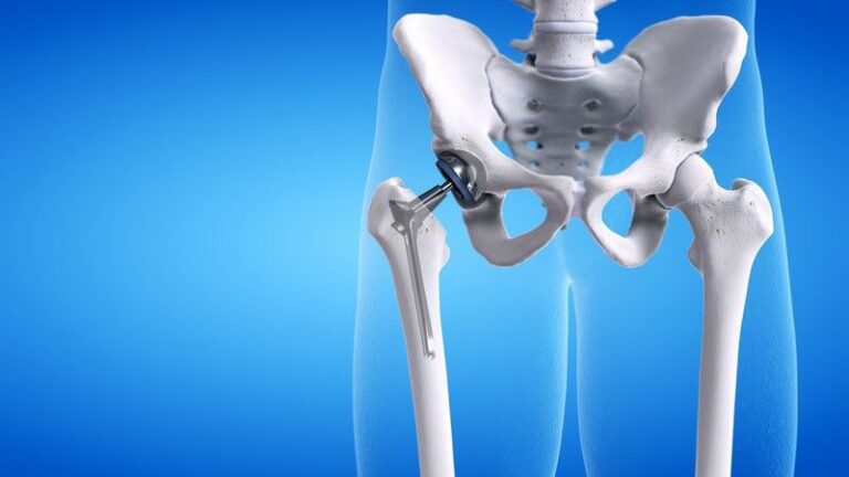 Imagem digital ilustrando um esqueleto humano com uma prótese de quadril implantada no fêmur, destacando a estrutura óssea e a substituição da articulação.