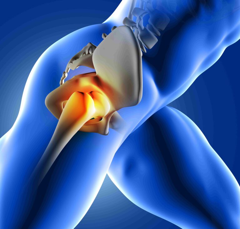 Ilustração anatômica 3D mostrando articulação do quadril com inflamação causada por artrose.