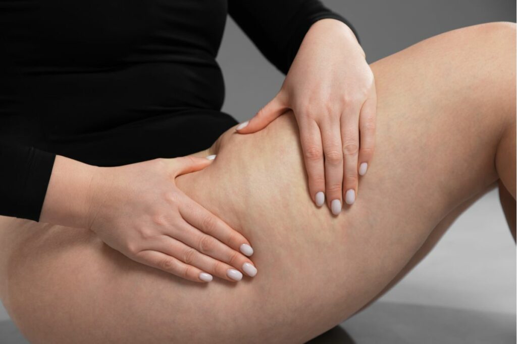 mitos e verdades no lipedema